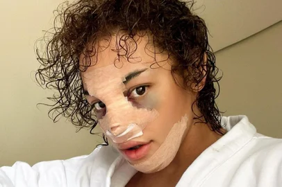 Pabllo Vittar faz rinoplastia<!-- NICAID(14971820) -->
