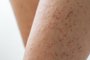 Legskin macro of a young woman suffering from pillar keratosis, frequent cause of atopic dermatitis and sketchyFonte: 495649018<!-- NICAID(15614274) -->