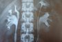 Com quatro rins, professora de Horizontina tem a mesma síndrome rara diagnosticada em bebê de Goiás