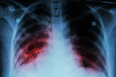 Pulmonary Tuberculosis ( TB )  :  Chest x-ray show alveolar infiltration at both lung due to mycobacterium tuberculosis infectionFonte: 84222367<!-- NICAID(15510903) -->