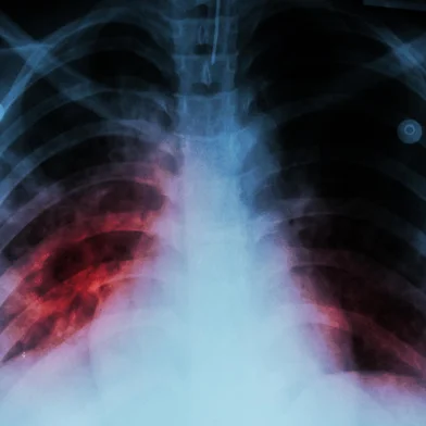 Pulmonary Tuberculosis ( TB )  :  Chest x-ray show alveolar infiltration at both lung due to mycobacterium tuberculosis infectionFonte: 84222367<!-- NICAID(15510903) -->