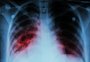 o Fundo tem o maior número de casos de tuberculose desde 2015