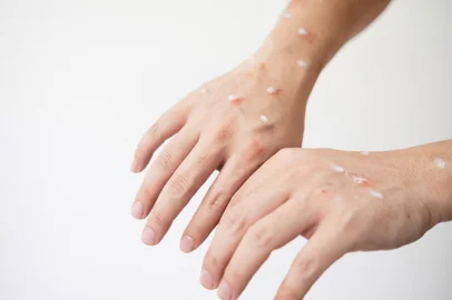 Concept of monkey pox infection, a white Asian man with pustular skin from monkeypox virus infection.varíola dos macacos. Foto:  Somboon / stock.adobe.comIndexador: Somboon KeaoboonsongFonte: 519099018<!-- NICAID(15185052) -->