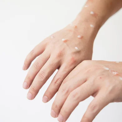 Concept of monkey pox infection, a white Asian man with pustular skin from monkeypox virus infection.varíola dos macacos. Foto:  Somboon / stock.adobe.comIndexador: Somboon KeaoboonsongFonte: 519099018<!-- NICAID(15185052) -->