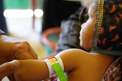 Enfermeira de MSF mede a circunferência do braço do bebê Suraiya, diagnosticado com desnutrição no acampamento de Al-Sweida, no Iêmen.<!-- NICAID(16306592) -->