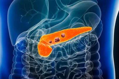 Pancreas or pancreatic cancer with organs and tumors or cancerous cells 3D rendering illustration with male body. Anatomy, oncology, disease, medical, biology, science, healthcare concepts.<!-- NICAID(16310008) -->