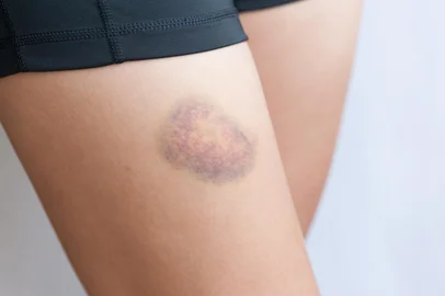 people with bruised leg closeuppeople with bruised leg closeup - Foto: lzf/stock.adobe.comIndexador: Li ZhongfeiFonte: 271202257<!-- NICAID(15488137) -->
