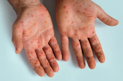 Human Hands with Painful Rash, Red Spots Blisters on the Skin. Health Problem. Monkeypox Disease Symptoms. Male Patient Arms with Monkey Pox. Close Up. Banner, Copy Space. Dengue Fever Infection, MPOXMPOX. Foto: Marina Demidiuk / stock.adobe.comFonte: 744724137<!-- NICAID(15844668) -->