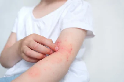 The child scratches atopic skin. The child applies a special cream to atopic skin. Dermatitis, diathesis, allergy on the child's body.Fonte: 511833649<!-- NICAID(15475807) -->