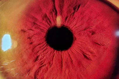Final 292: Cirurgia com lente intraocular Alcon VivityFinal 084304: Cirurgia com lente intraocular Alcon PanoptixFinal 081906-01: Cirurgia com lente intraocular Alcon ClareonFinal 082207: Cirurgia com lente intraocular Alcon Panoptix<!-- NICAID(14814972) -->