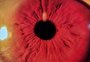Como é a cirurgia de catarata com implante de lentes intraoculares