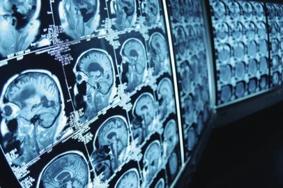 cérebro, neurônios, avc