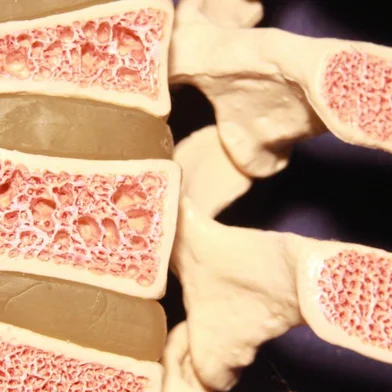 Model of spine showing porous bone marrow in case of osteoporosisFonte: 259754779<!-- NICAID(14917936) -->