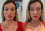 O que é queratopigmentação? Saiba os perigos da cirurgia para mudança da cor dos olhos