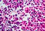 Linfoma: causas, sintomas e tratamento deste tipo de câncer
