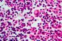 Hodgkin's lymphoma, light micrographHodgkin's lymphoma, light micrograph, photo under microscopeFonte: 296611237<!-- NICAID(15215380) -->