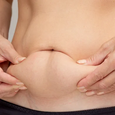Hands on belly pressed skin to show sagging skin after diet and stretch marks after pregnancyConceito de gordura abdominal - Foto: Tatiana Foxy/stock.adobe.comFonte: 773968933<!-- NICAID(15909282) -->