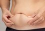 "Umbigo triste"? Entenda o fenômeno e como tratar a flacidez e o excesso de pele abdominal 