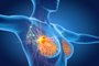 *A PEDIDO DE GABRIELA PERUFO* 3d illustration showing breast cancer with lymphatics on black background - Foto: Axel Kock/stock.adobe.comFonte: 302042936<!-- NICAID(15206733) -->