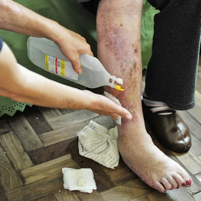 ALVORADA, RS, BRASIL, 29-04-2013: Noeli Deolindo Lumertz, 54 anos, limpa feridas na perna da mãe, Ana Schutz Lumertz, 85, no quarto da casa onde moram, em Alvorada. A idosa sofre de varicose erisipela e está com dificuldades para obter no posto de saúde os materiais necessários para as trocas diárias de curativos. (Foto: Mateus Bruxel / Diário Gaúcho)<!-- NICAID(9330051) -->
