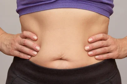 Cropped woman body with hands on waist showing belly sagging skin after diet and stretch marksConceito de gordura abdominal - Foto: Tatiana Foxy/stock.adobe.comFonte: 692481006<!-- NICAID(15909281) -->
