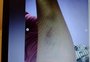 Estudante de Direito relata ter sido espancada pelo namorado em Charqueadas e posta fotos nas redes