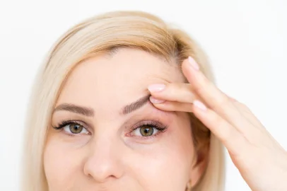 woman shows drooping eyelid for plastic surgeryPalpebras, cirurgia plástica. Foto: Angelov   /stock.adobe.comIndexador: sinenkiyFonte: 423986935<!-- NICAID(14880567) -->