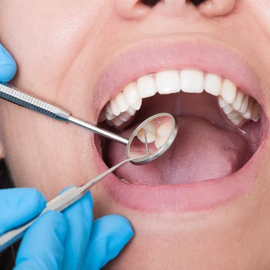 Closeup of dentist tools and mouth open with beautiful teeth<!-- NICAID(16118170) -->