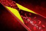 Anvisa aprova novo remédio contra colesterol que pode ser usado duas vezes ao ano
