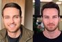 Harmonização facial: confira famosos que fizeram o procedimento