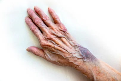 Reprodução / adobe.stock.com A bruise after an unsuccessful fall on the hands of an elderly man. Old age. wrinkled skin. an elderly woman with bruises on her hands is playing cards, keeping score. isolated on a white background<!-- NICAID(16205466) -->