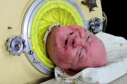Paul Alexander, o homem que sobreviveu a polio entubado em um pulmão de ferro, morre - Foto: GoFundMe/Reprodução<!-- NICAID(15704489) -->