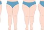 Lipedema afeta principalmente mulheres