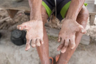 Doença de Hansen Foto: frank29052515 / stock.adobe.comFonte: 108794062<!-- NICAID(15650919) -->
