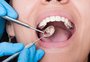 Alimentos ultraprocessados aumentam em 28% os casos de dor de dente em adolescentes, aponta estudo
