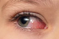 Closeup irritated infected red bloodshot eyes, conjunctivitisCloseup irritated infected red bloodshot eyes, conjunctivitis. Foto: andrei310 / stock.adobe.comFonte: 673492911<!-- NICAID(16164128) -->