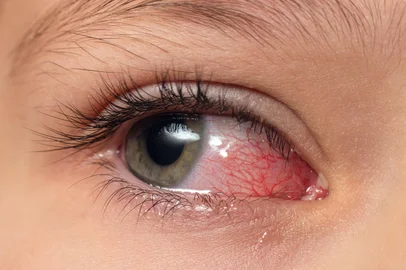 Closeup irritated infected red bloodshot eyes, conjunctivitisCloseup irritated infected red bloodshot eyes, conjunctivitis. Foto: andrei310 / stock.adobe.comFonte: 673492911<!-- NICAID(16164128) -->