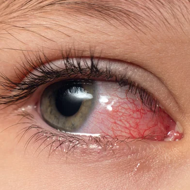 Closeup irritated infected red bloodshot eyes, conjunctivitisCloseup irritated infected red bloodshot eyes, conjunctivitis. Foto: andrei310 / stock.adobe.comFonte: 673492911<!-- NICAID(16164128) -->