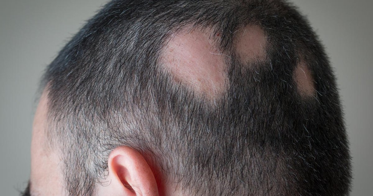 O que é a queda de cabelo conhecida como alopecia areata? Veja causas e tratamentos recomendados | GZH