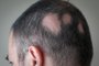 09/02/2021- Alopecia, cabeça, couro cabeludo, cabelo, Calvície. Foto: Alex Papp /stock.adobe.comFonte: 140708548<!-- NICAID(14710135) -->