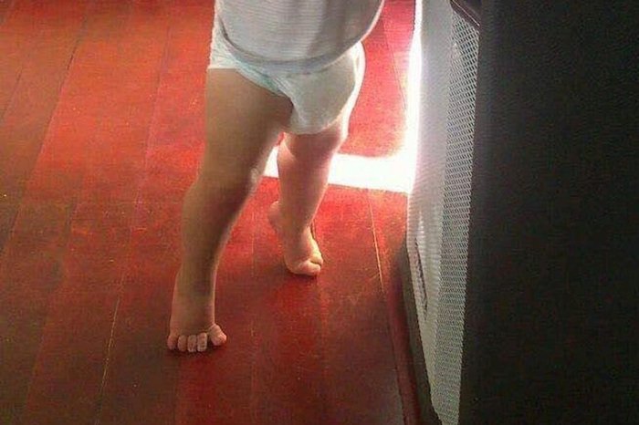 Taylor sofria com o encurtamento desde bebê