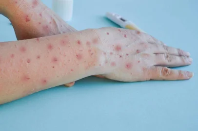 Passo Fundo registra primeiro caso de Mpox em 2024<!-- NICAID(15843981) -->