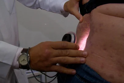 Ambulatório da UCPel é o único de referência no tratamento da psoríase no sul do RS<!-- NICAID(16155755) -->