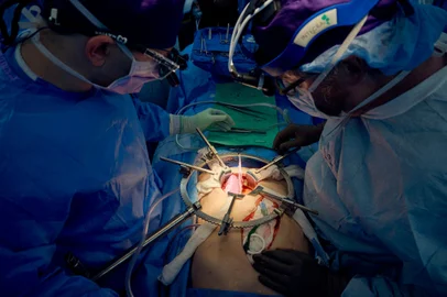 This July 14, 2023, image released by NYU Langone Health in New York, shows a team of surgeons transplanting a pig kidney. The genetically-modified pig kidney is continuing to function well into a record-breaking 32 days, after it was transplanted into a brain dead patient, the medical center said on August 16, 2023. "This work demonstrates a pig kidney - with only one genetic modification and without experimental medications or devices -- can replace the function of a human kidney for at least 32 days without being rejected," said surgeon Robert Montgomery, director of the NYU Langone Transplant Institute. (Photo by Joe Carrotta / NYU Langone Health / AFP) / RESTRICTED TO EDITORIAL USE - MANDATORY CREDIT "AFP PHOTO / NYU Langone Health" - NO MARKETING NO ADVERTISING CAMPAIGNS - DISTRIBUTED AS A SERVICE TO CLIENTSEditoria: HTHLocal: New YorkIndexador: JOE CARROTTASecao: biotechnologyFonte: NYU Langone HealthFotógrafo: Handout<!-- NICAID(15512178) -->