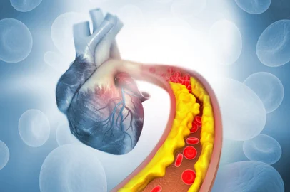 Cholesterol plaque in artery with Human heart anatomyCholesterol plaque in artery with Human heart anatomy. 3d illustration  Fonte: 292820668<!-- NICAID(15240786) -->