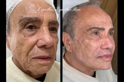 Stenio Garcia mostra resultado de harmonização facial<!-- NICAID(15456272) -->