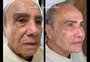 Harmonização facial de Stenio Garcia: há limite de idade e de quantidade de material aplicado?