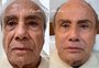 Stenio Garcia mostra resultado de harmonização facial