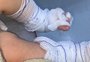 Bebê de 11 meses tem queimaduras de segundo grau depois de banho em escola 