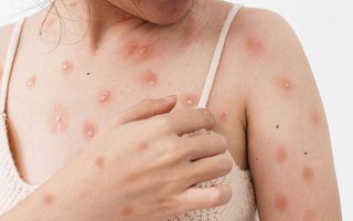 Concept of monkeypox epidemic, white woman Skin erythema, pustules, and boils, itching after being infected with the monkeypox virus.*A PEDIDO DE GABRIELA PERUFO* Vírus da monkeypox, a varíola do macaco - Foto: Somboon/stock.adobe.comIndexador: Somboon KeaoboonsongFonte: 508884278<!-- NICAID(15233880) -->